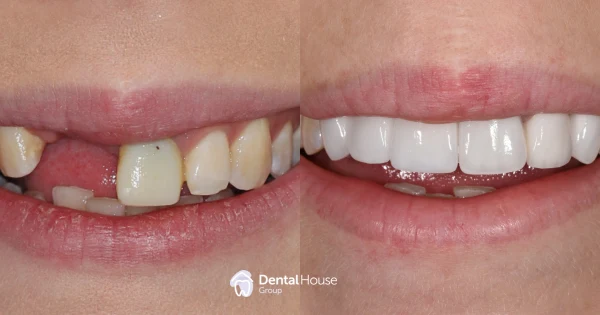 Conservative Implant Restoration Clinical Case in Gisborne