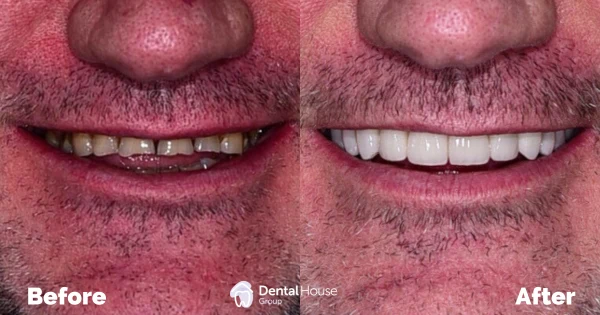 Conservative Reconstruction Clinical Case in Gisborne