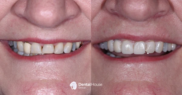 Conservative Restoration Clinical Case in Gisborne