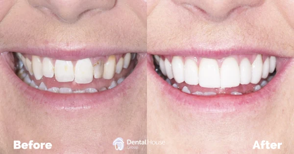 Conservative Restorative Treatment Clinical Case in Gisborne