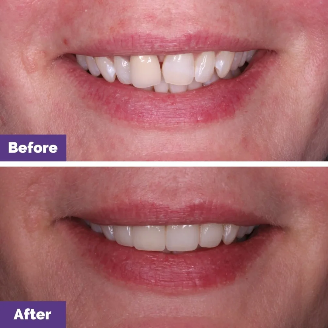 Crown Veneer Replacement Case Study