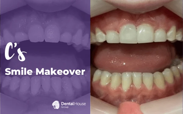 Cs Smile Makeover in Bacchus Marsh