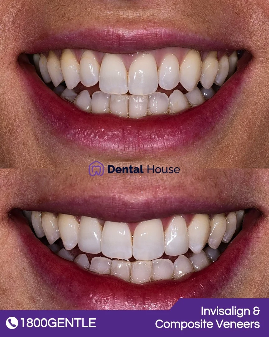Invisalign &# Composite Veneers