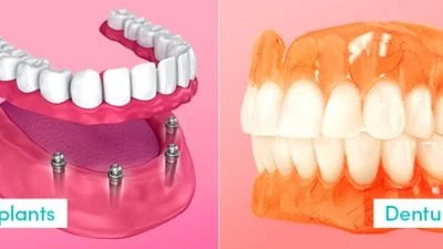 Dentures Vs Dental Implants