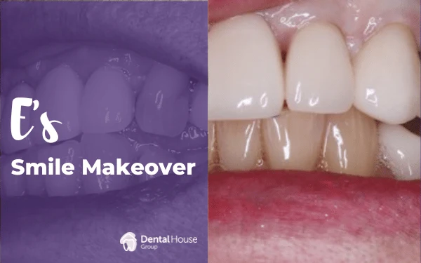 Es Porcelain Crowns in Gisborne