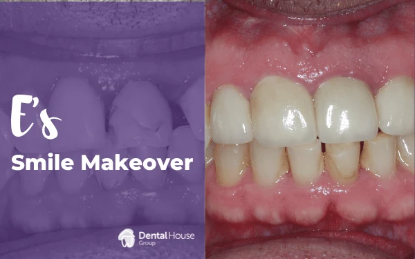 Es Smile Makeover in Gisborne