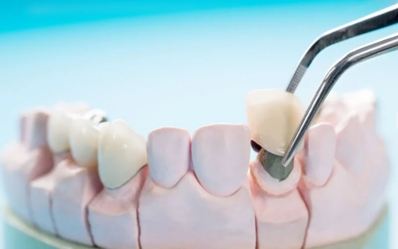 Fixed Prosthodontics What Are They Why Are They Suddenly Famous