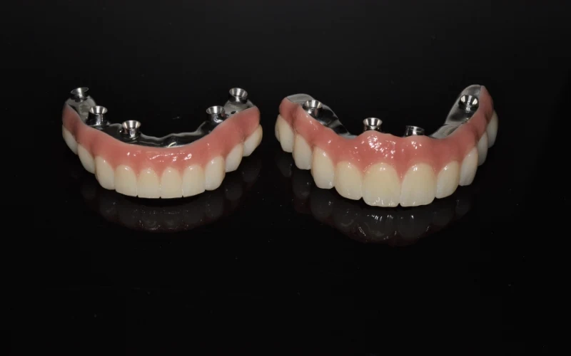 From Wobbly to Wow How All On Plus Tackles Severe Tooth Mobility