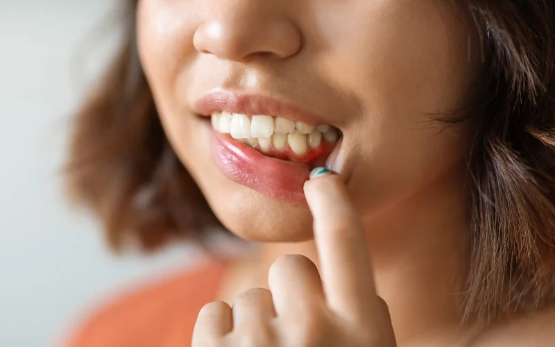 Home Care Gingivitis Treatments To Help Stop Its Progression