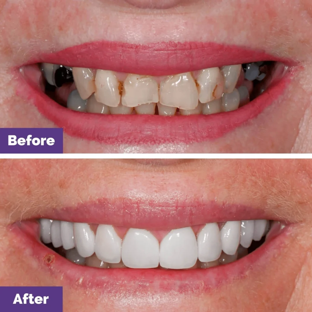 How Effective is Combined Porcelain Veneer and Crown Treatment in Sunbury