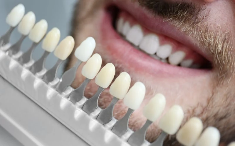How Long Do Veneers Really Last The Timeline Nobody Tells You