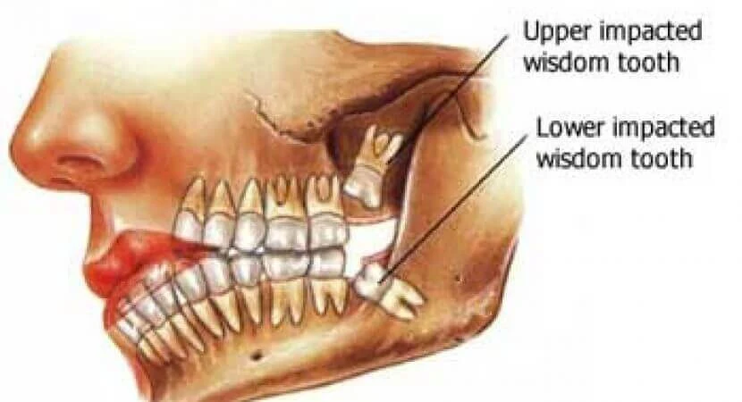 How Many Wisdom Teeth Do People Have