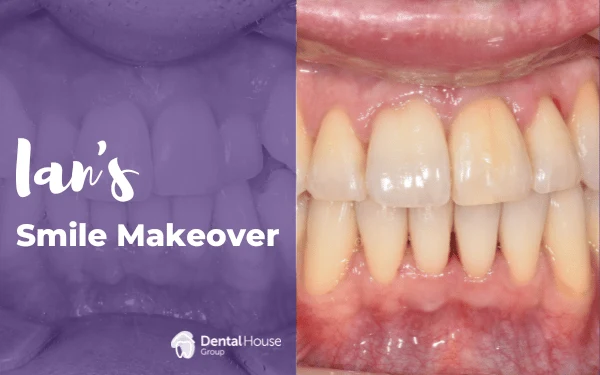 Ians Invisalign Smile Makeover in Bacchus Marsh