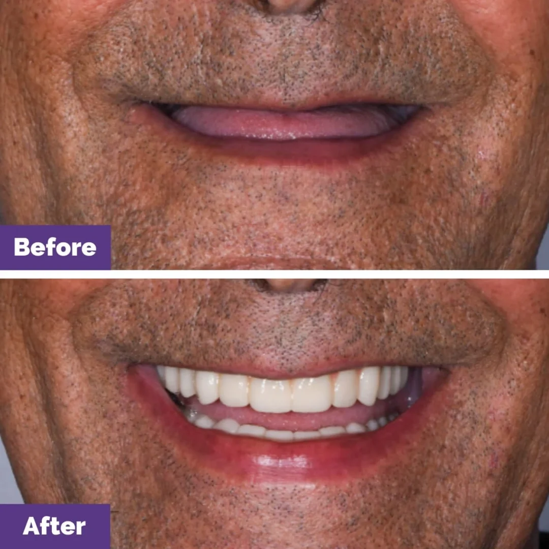ImplantSupported Denture Case Study
