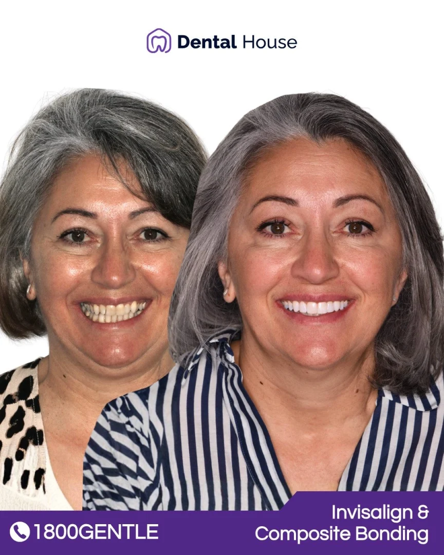 Invisalign &#; Composite Bonding