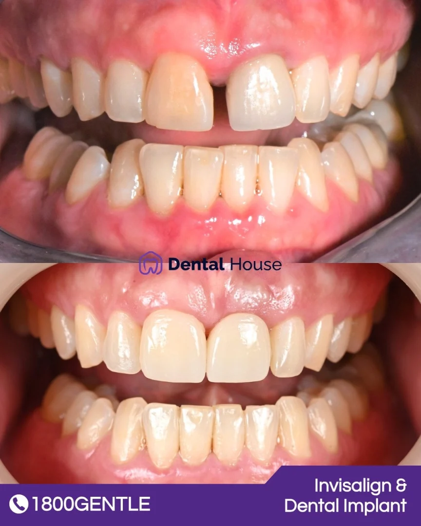 Invisalign &# Dental Implant