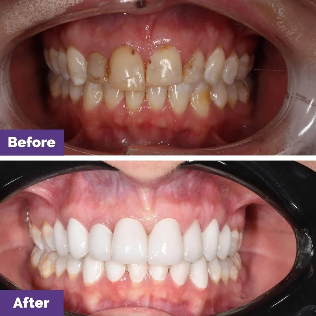 Invisalign Gap Closure Case Study