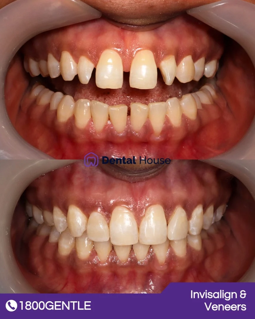 Invisalign &# Veneers
