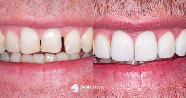 Invisalign Veneers Case Study in Bacchus Marsh