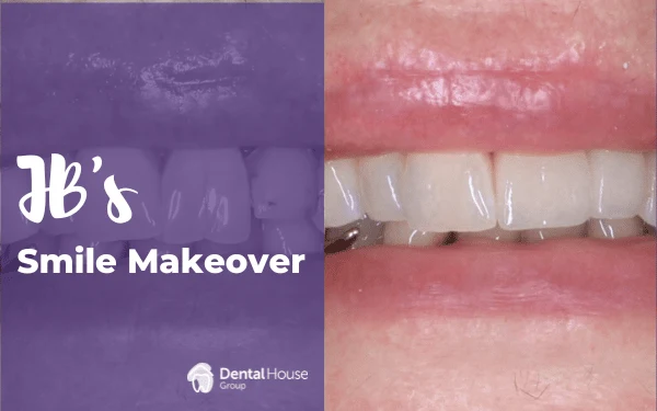 JBs Porcelain Crowns in Gisborne