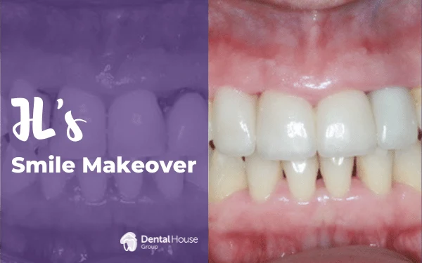 JLs Porcelain Veneers Crowns in Gisborne