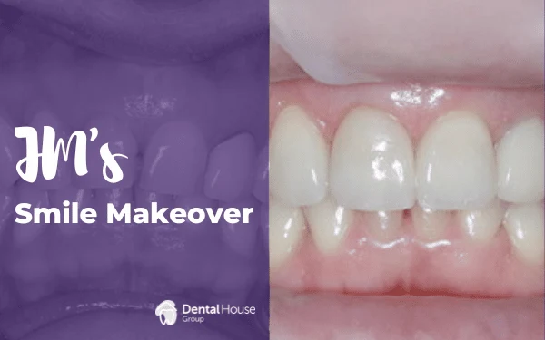JMs Porcelain Veneers Whitening in Gisborne