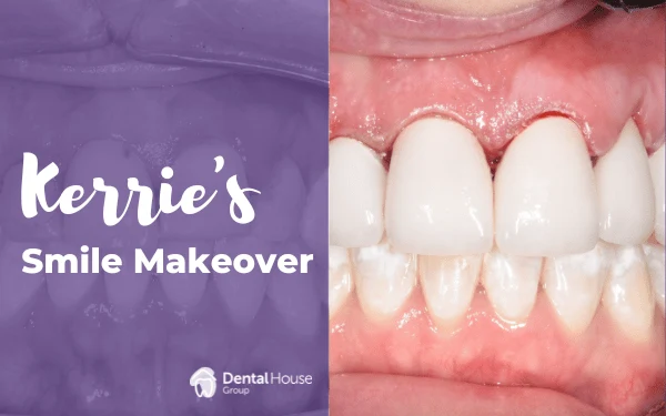 Kerries Smile Make over in Sunbury