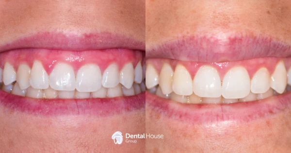 Laser Gingivectomy Case Study in Sunbury