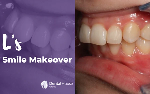 Ls Invisalign Smile Makeover in Bacchus Marsh