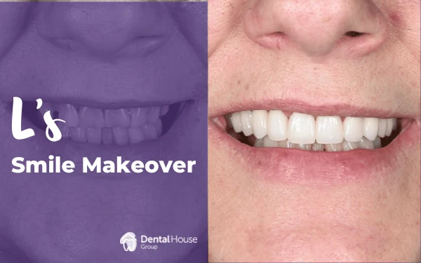 Ls Smile Makeover in Sunbury