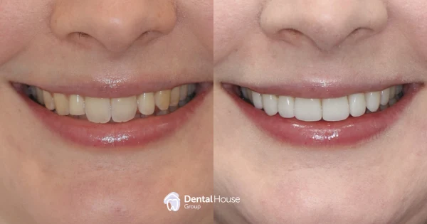 Minimal Preparation Veneers Clinical Case in Gisborne