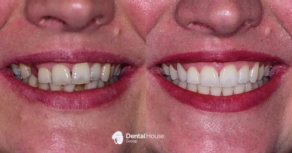 Minimally Invasive Tooth Replacement Clinical Case in Gisborne