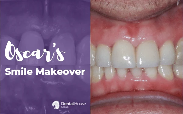 Oscars Porcelain Crown Veneers in Gisborne