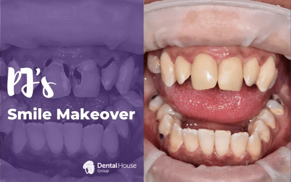 PJs Composite Veneers Journey in Sunbury