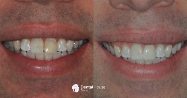 Porcelain Crown Discoloured Tooth Case Study in Sunbury