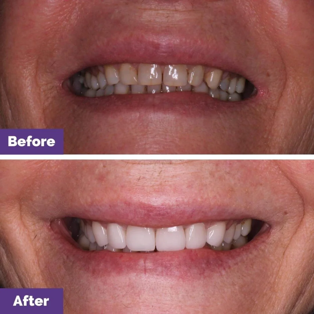 Porcelain Veneer Longevity Case Study