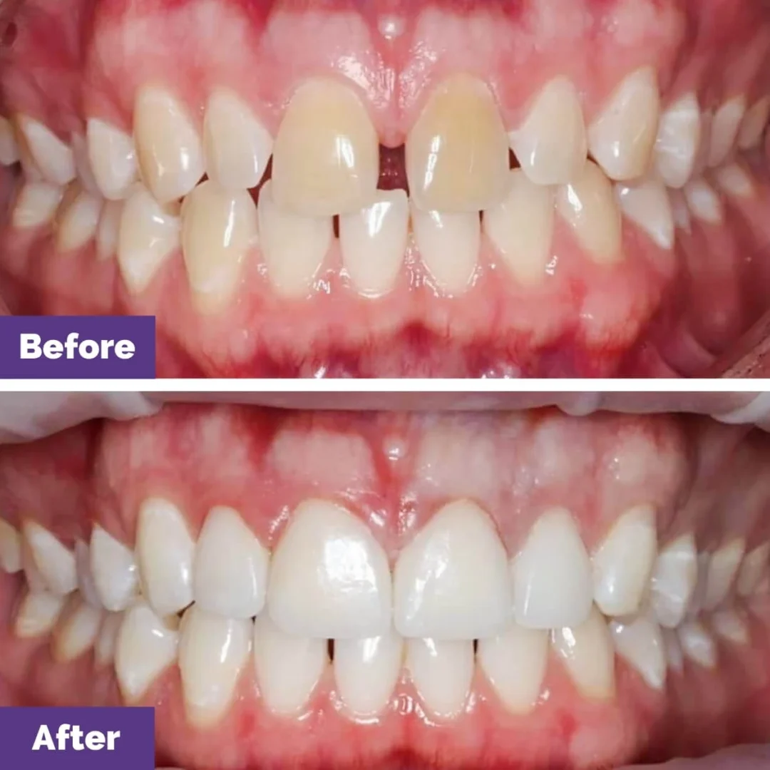 Porcelain Veneers Gap Closure Case Study