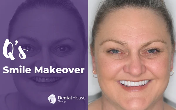 Qs Smile Makeover in Sunbury