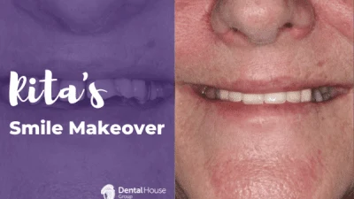 Ritas Smile Makeover in Bacchus Marsh