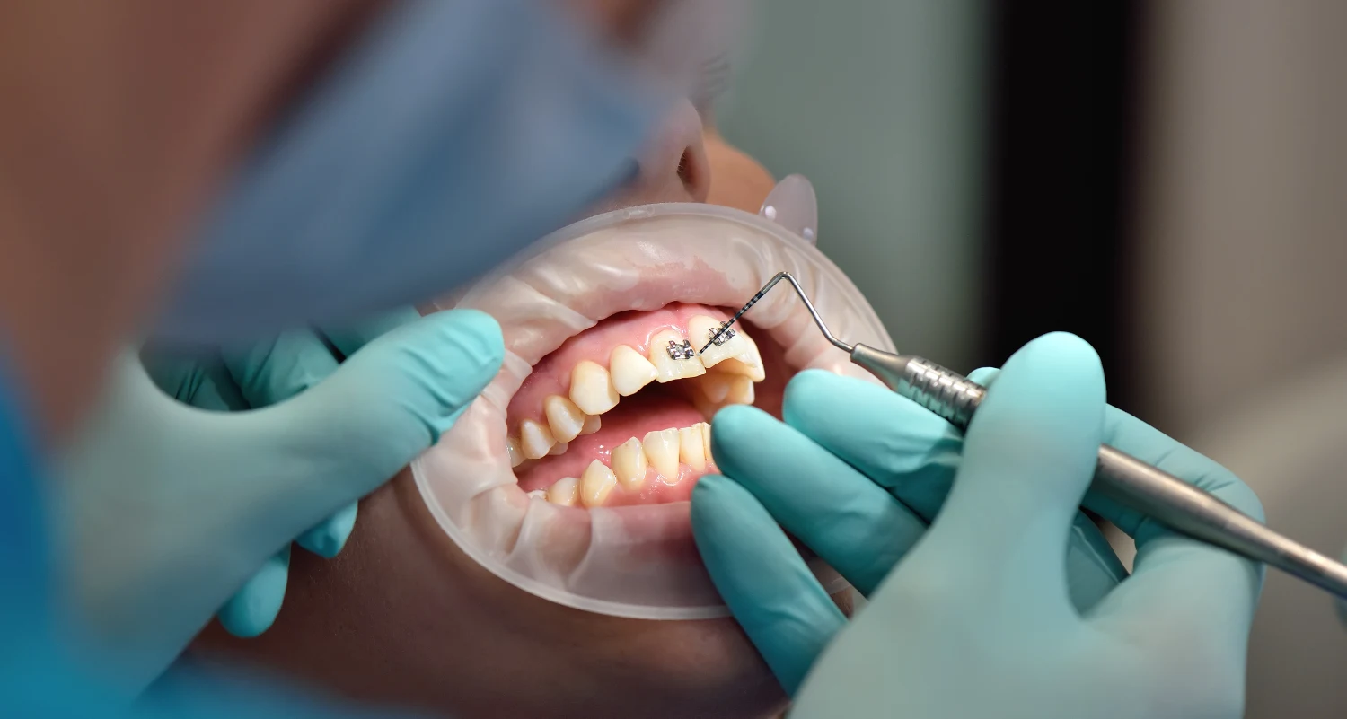 Sleep Dentistry for Gag Reflex When Your mouth Wont Cooperate
