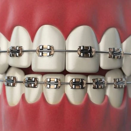 Straight Talk About Braces for Adults