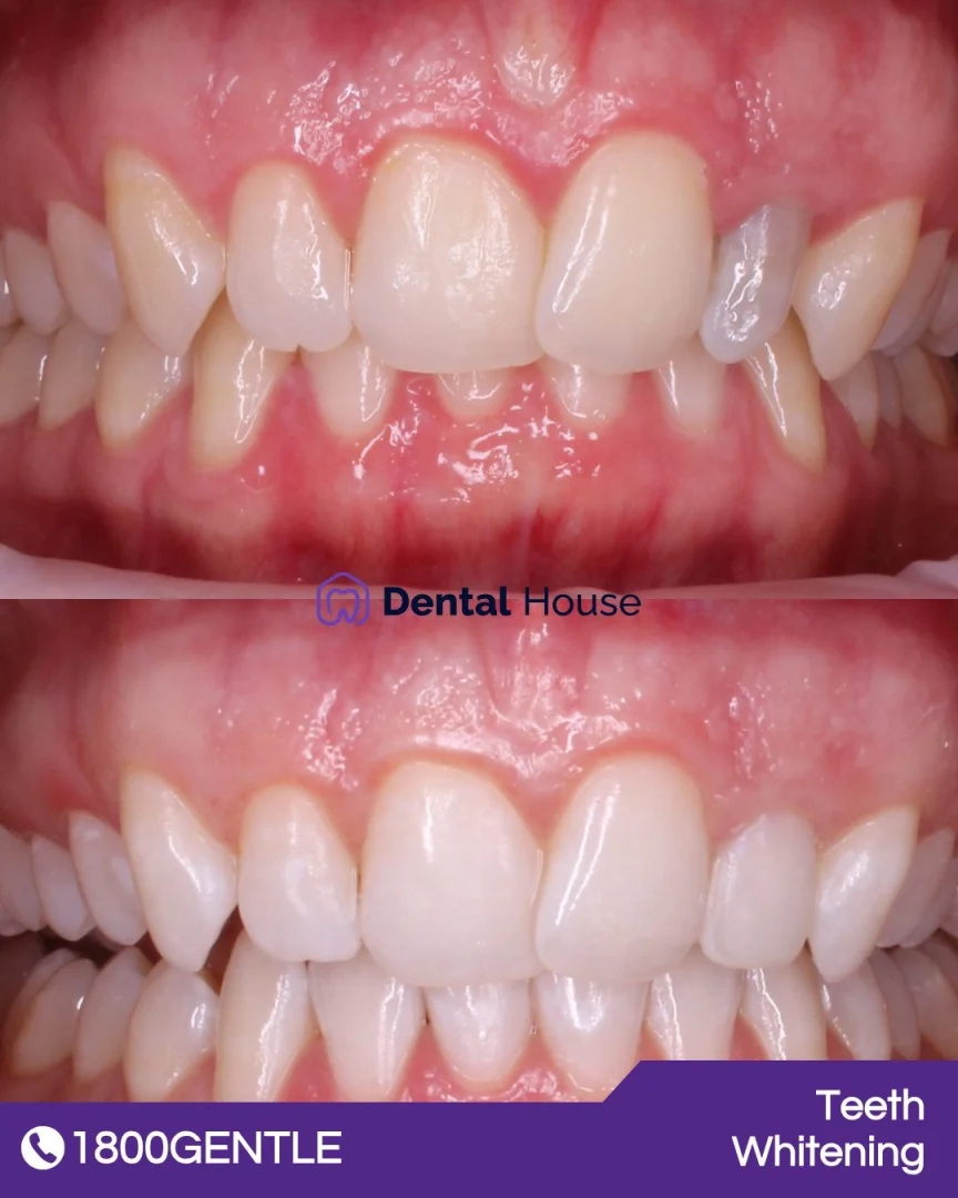 Invisalign &# Teeth Whitening