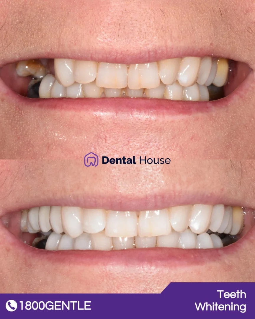 Teeth Whitening &# Dental Implant