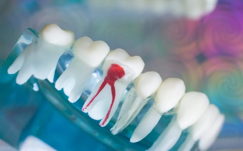 Treatment Options for Irreversible Pulpitis Dentists Directing Their Patients