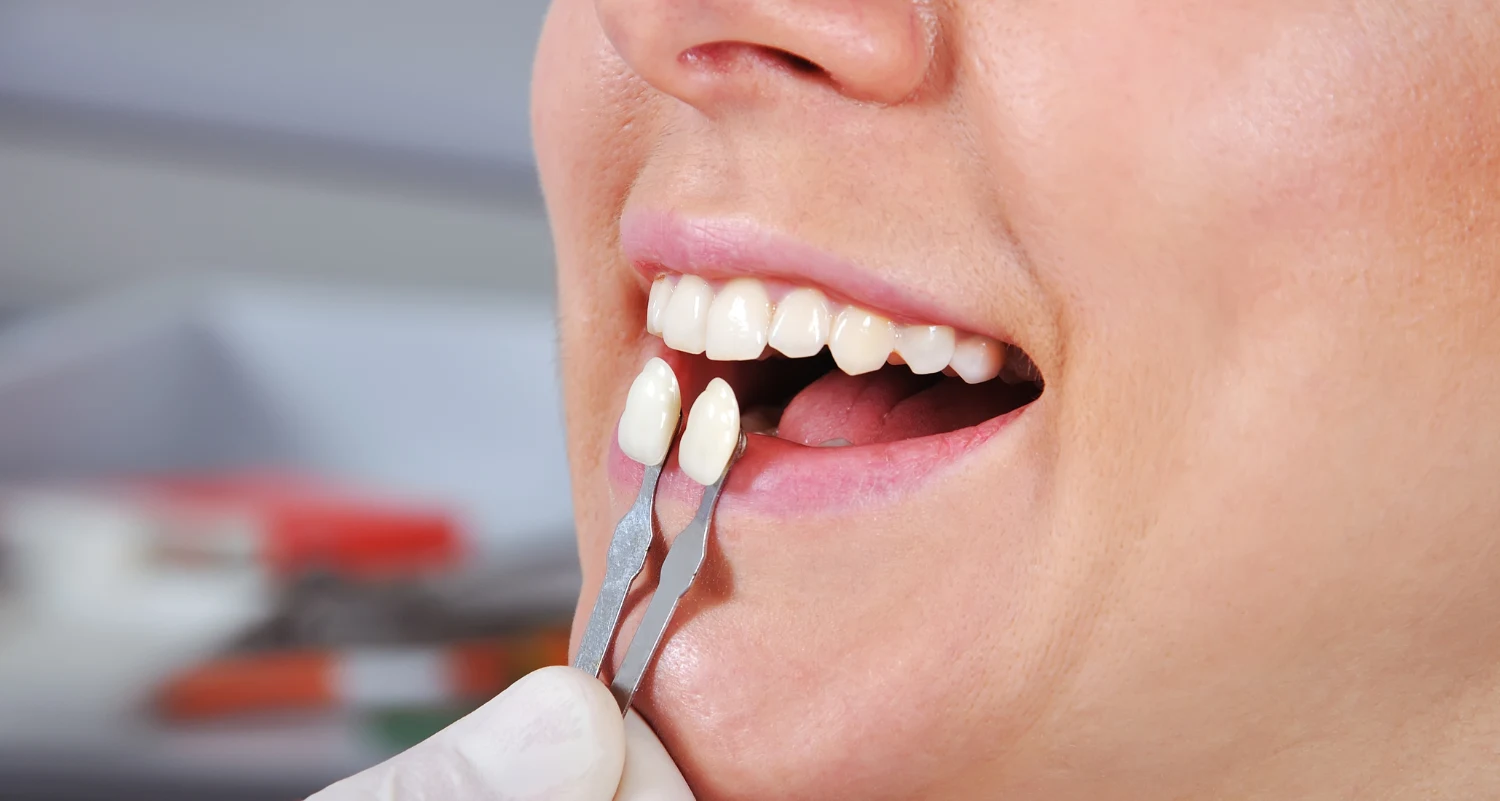 Veneers for Chips Gaps Stains Your Complete Guide