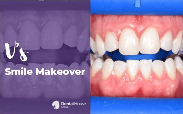 Vs Zoom Whitening Treatment in Melbourne
