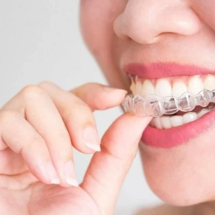 What to Know about Invisalign and Its Effectiveness