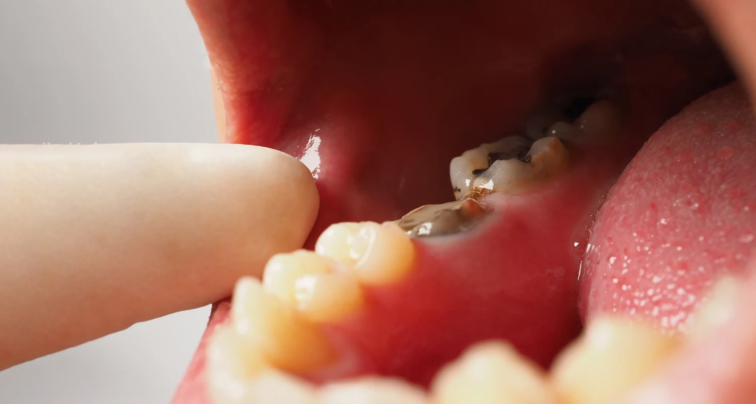 When Fillings Arent Enough The Complete Decay Restoration Guide