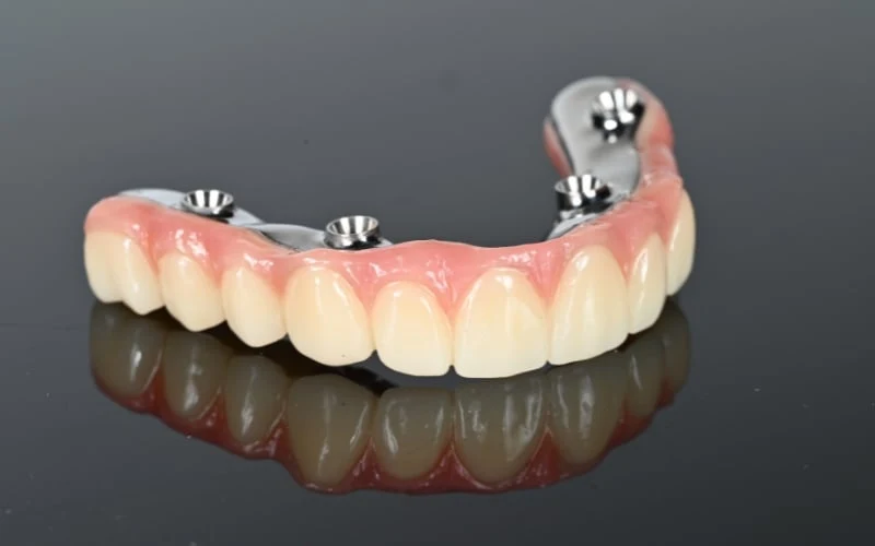 Why Allon Plus is the Gold Standard for Fixed Full Arch Replacement