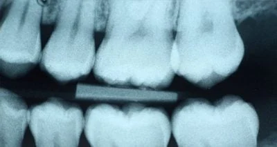 Why Dental Xrays Are Needed